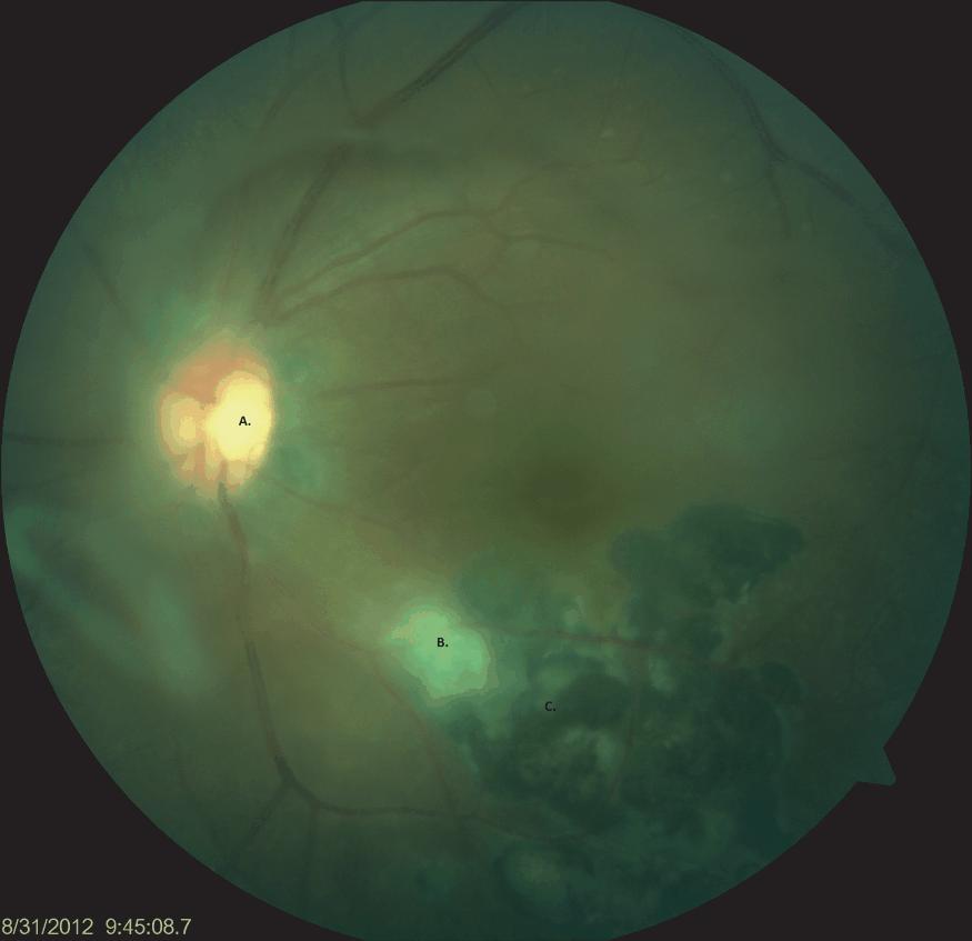 Figure 3: Color fundus photo from a 34-year-old immunocompetent female with multiple recurrences in the posterior pole. A. Weiss ring. B. Area of vitritis overlying active lesion. C. Chronic scarring from prior episodes.