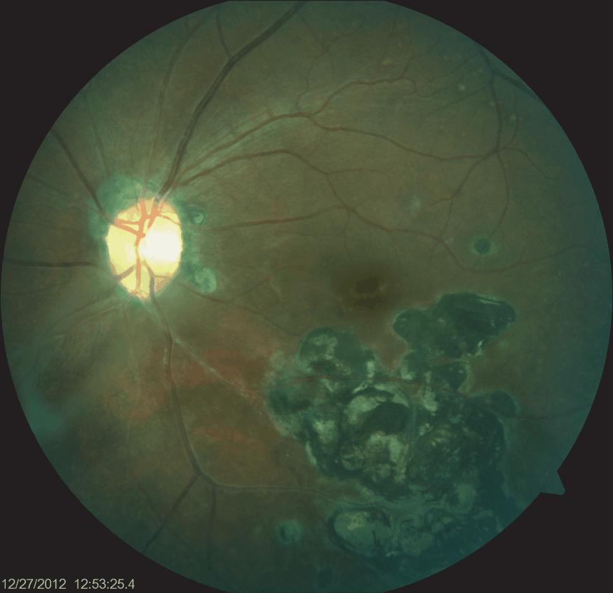 The classic presentation of congenital toxoplasmosis includes large macular retinochoroiditis, hydrocephalus, and intracranial calcification.
