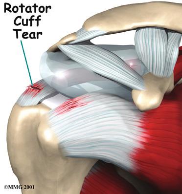 Bursae are located all over the body where tissues must rub against each other. In this case, the bursa protects the acromion and the rotator cuff from grinding against each other.