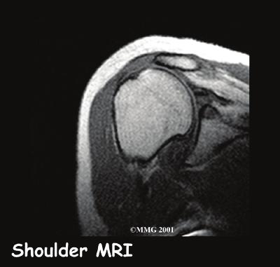 be painful, but you can still move the arm in a normal range of motion. In general, the larger the tear, the more weakness it causes. In other cases, the rotator cuff tendons completely rupture.