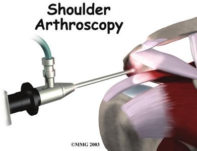 Arthroscopic Repair In the past, repair of the rotator cuff tendons usually required an open incision 3 or 4 inches in length.