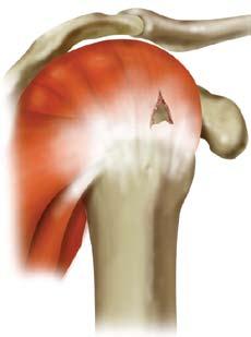 What is a Rotator Cuff Tear? The shoulder is a very complex joint; it is also the most mobile joint in the body.