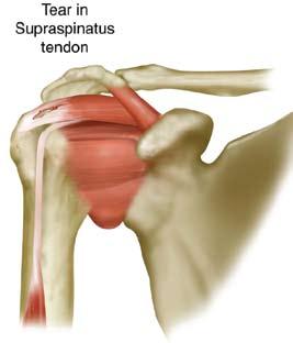Rotator Cuff Tears: Severe tendonitis from impingement, degeneration, or a sudden injury like a fall, can cause partial or complete tearing of the