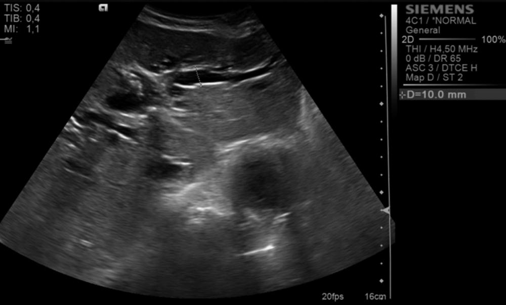 Archives of the Balkan Medical Union Figure 1. Ultrasound image of dilated intrahepatic bile ducts Figure 2.