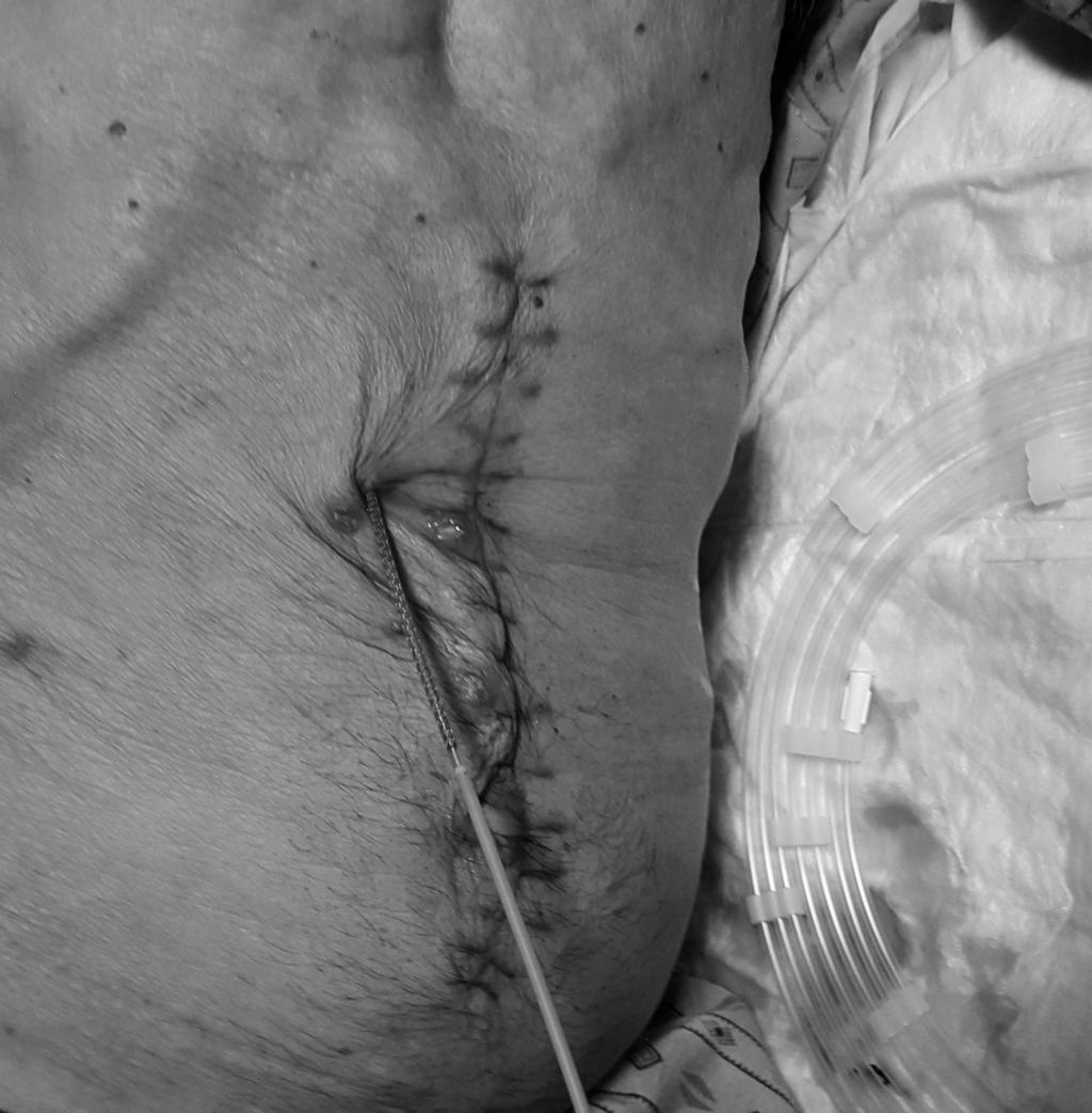 We decided to retrieve percutaneously the biliary drainage catheter. Before that, we inserted under fluoroscopic guidance a guidewire (Jagwire.