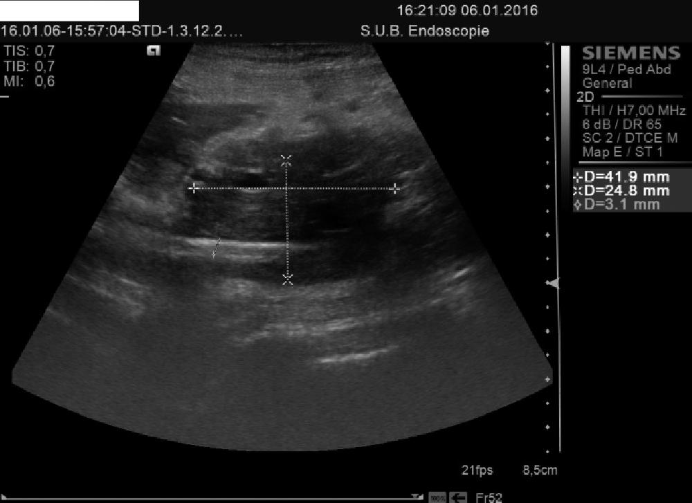 Percutaneous transhepatic biliary drainage in a patient with malignant stenosis CONSTANTINESCU et al Figure 6. SEMS image in pancreatic head Figure 7.