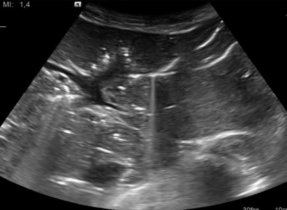 After the procedure, we repeated the ultrasound which confirmed the correct position of the stent (Figure 6) and also the presence of significant aerobilia, demonstrating the biliary drainage into