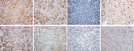 , Immunohistohemil nlyses of tumours from dele746_a75/t79m mie from using indited ntiodies. Sle r, 5 mm.