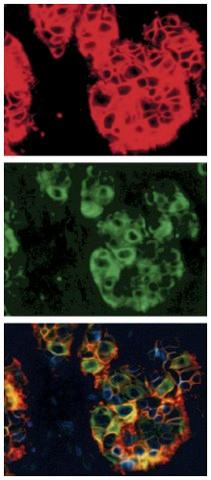 Deregulation of Receptor Firing: Autocrine Signaling in Human Breast Carcinoma Over-expression of EFG receptor (EGFR) (red)