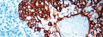 COX-2 staining increases in the more differentiated, suprabasal keratinocytes of normal skin. COX-2 is expressed in epithelial and interstitial cells of adenomatous polyps and colon adenocarcinomas.