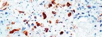 : PDR 034 Prediluted 6ml PDR034-10RP Prediluted 10ml Regulatory Status: RUO Formalin fixed paraffin embedded tissue stained with HSV I antibody (RP 018).