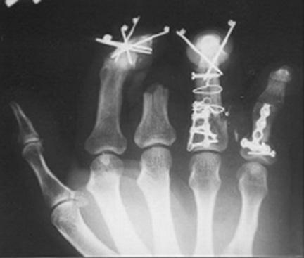 4. X-ray of Bone Fixations.