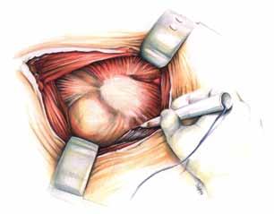 The Approach to the Deeper Layers The fascia lata is incised and dissociated of the fibers of the M. gluteus maximus and the Charnley wound retractor is placed directly on the fascia.