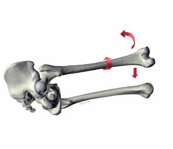 The tendon attachment is partly released in order to relax the soft parts. This favours the displacement of the femur in the ventral direction and also its internal rotation.