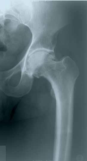CLS Spotorno Hip Stem Surgical