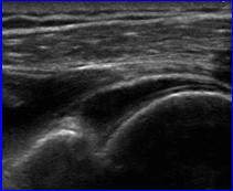 site* Acromioclavicular Joint In plane Transducer: coronal Lateral to medial IST C G H A Eur Radiol 2011; 21:1858