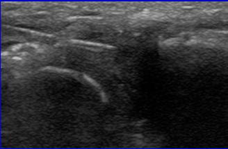 steroids into tendon Risk of tendon rupture Test needle location with Lidocaine first Biceps Brachii: sheath injection