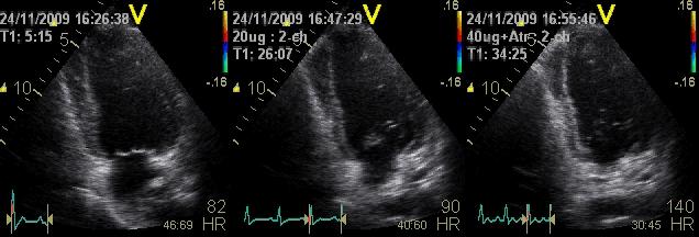Stress Echocardiography regional wall motion normal ischemic viable viable+ ischemic scar baseline low dose