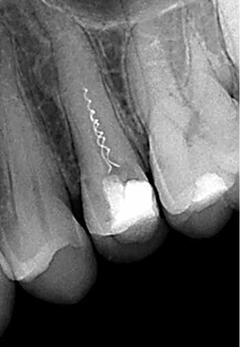 Success rate Influence of fractured files on outcome of endodontic treatment Strindberg 8 73% Reduction of 19% Engström et al 9 67% No effect Engström and Lundberg 10 100% No effect Grossman 11 77%
