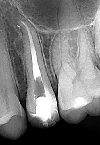 success rate on tooth necrosed Molyvdas et al 15 87% Reduction in the success rate if periapical lesion Table 1. Influence on the success rate reviewed in the literature. inappropriate use.