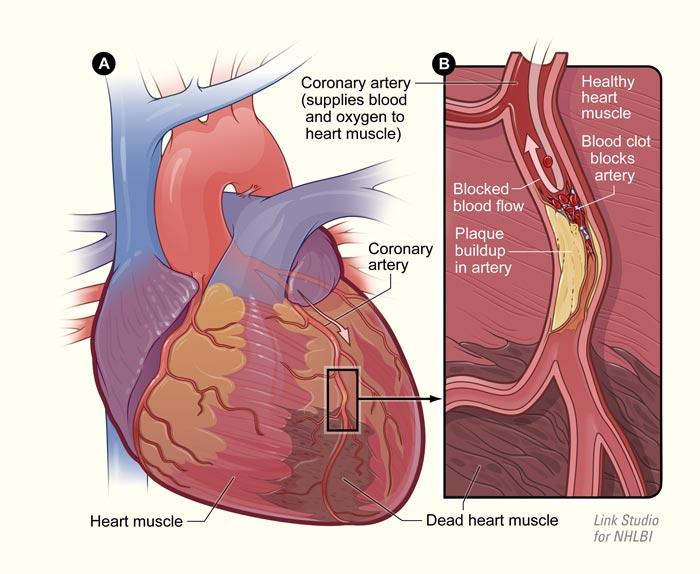 4 million adults in the US live with coronary heart disease (CHD) and
