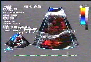 Axis Color Doppler: 