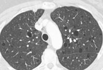 Cystic Lung Diseases Cystic lung diseases Aurelie Fabre Increased Awareness Spontaneous Pneumothorax High resolution imaging (HRCT) Multidisciplinary approach like interstitial lung disease CT
