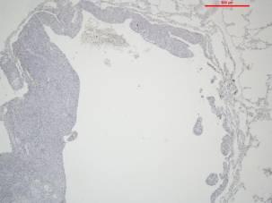 cases of LCH provides additional evidence of the neoplastic nature of the