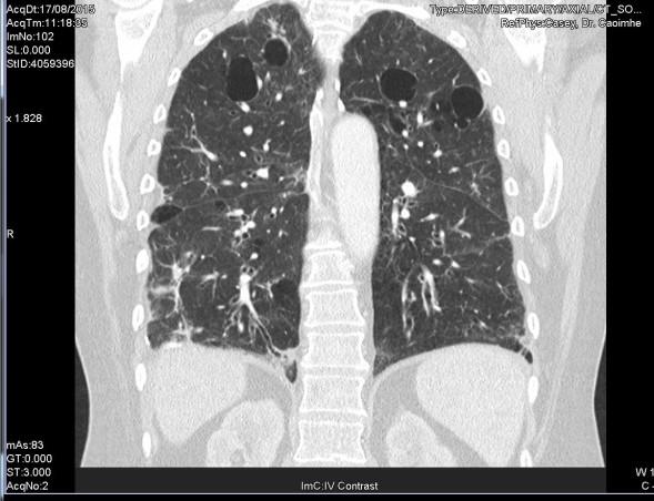 in most cases multiple, irregular-shaped cysts of various sizes, round or oval lower/ medial lung zone predominance abutting or including the proximal portions of lower pulmonary arteries or veins