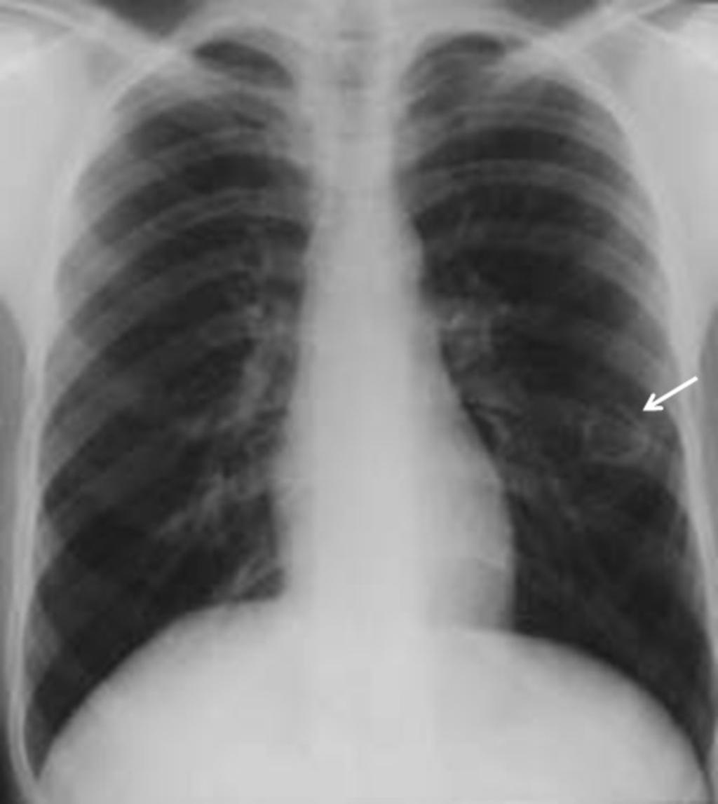 Fig. 9: Posteroanterior chest radiograph shows a cystic lesion in the