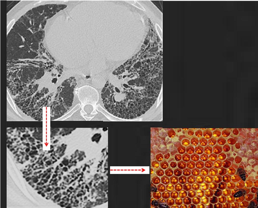 Fig. 14: pulmonary fibrosis with prominent