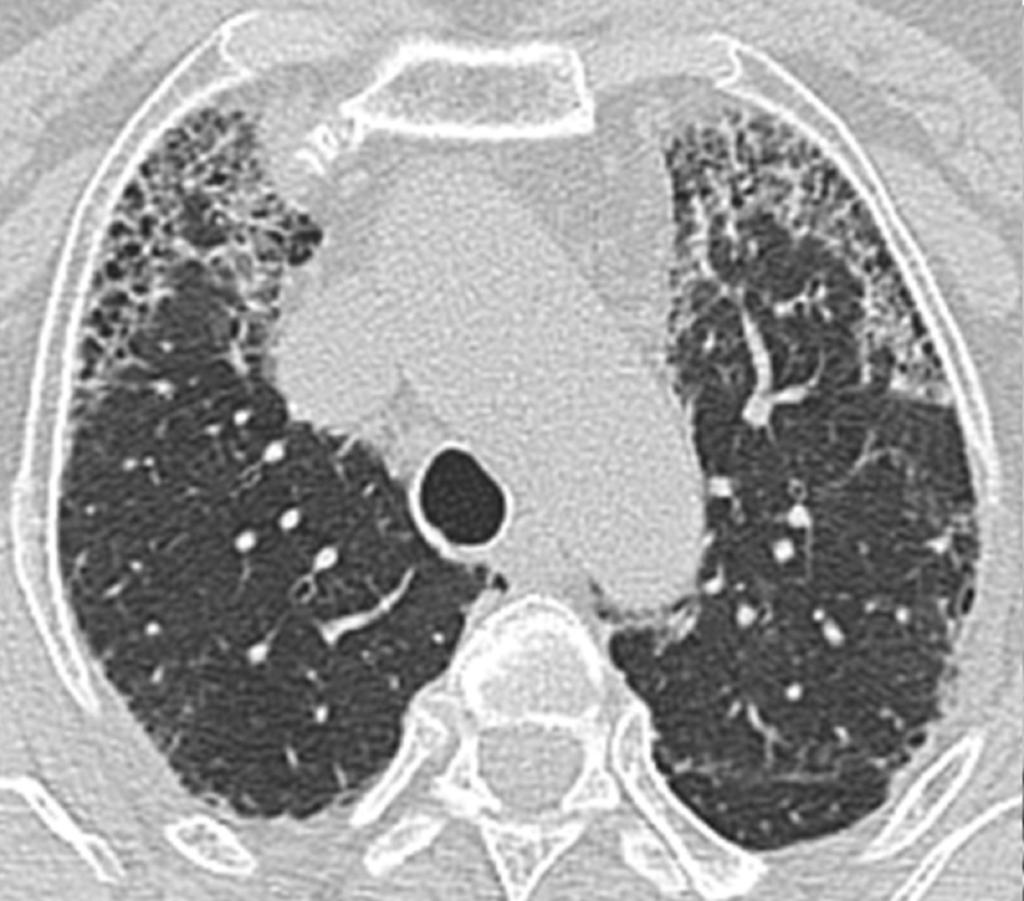 Fig. 15: The honeycombing in patient with non-specific interstitial pneumonia.