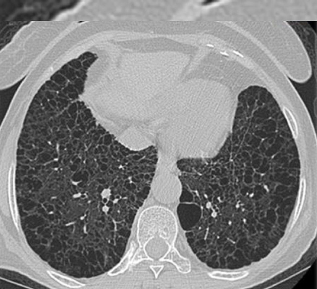Fig. 16: Axial MDCT image, obtained in patient with progressive dyspnea and pulmonary