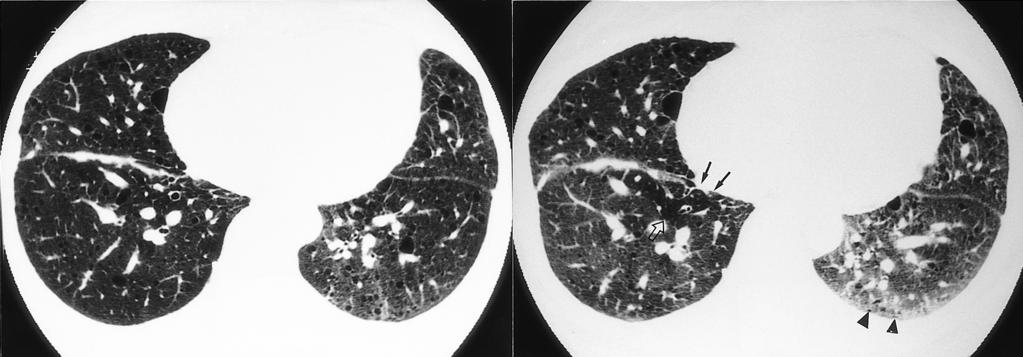 Cystic Lung Disease sponse to diseases which include Langerhans cell histiocytosis, lymphaniomyomatosis, cystic bronchiectasis, honeycombing and confluent centrilobular emphysema, paraseptal