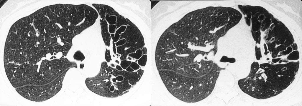 Cystic Lung Disease Fig. 6. 34-year-old woman with cystic bronchiectasis, who presented with purulent sputum and cough.