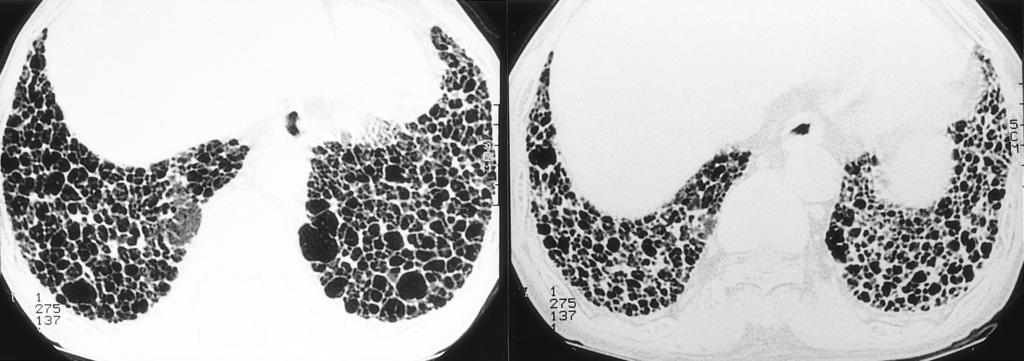 . Expiratory CT scan at nearly the same level as shows marked decrease in the size of cystic lesions Fig. 7. 58-year-old man with end-stage (honeycomb) lung, who presented with dyspnea and dry cough.