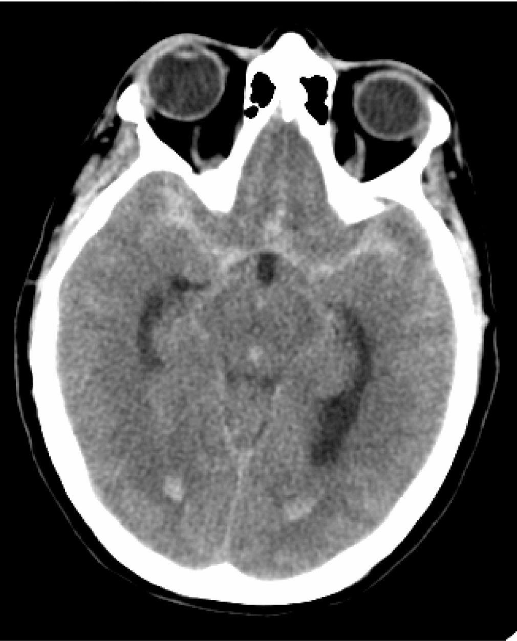 8 Figure 1. Non contrast head CT scan demonstrating diffuse SAH with intraventricular blood (modified Fisher grade 4).
