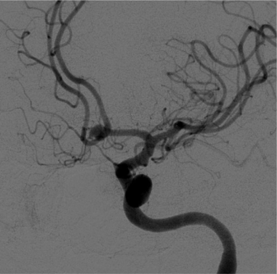 Zhang et al. 9 Figure 2. Left internal carotid artery angiogram demonstrating a 3.9 mm 4.1 mm anterior communicating artery aneurysm (Acom) with normal caliber anterior cerebral arteries. Figure 3.
