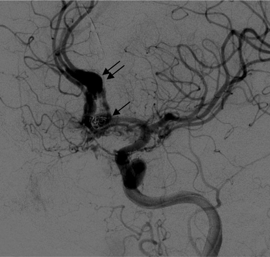 strated moderate to severe vasospasm in the A2 segment of both anterior cerebral arteries (double arrows, Figure 4).