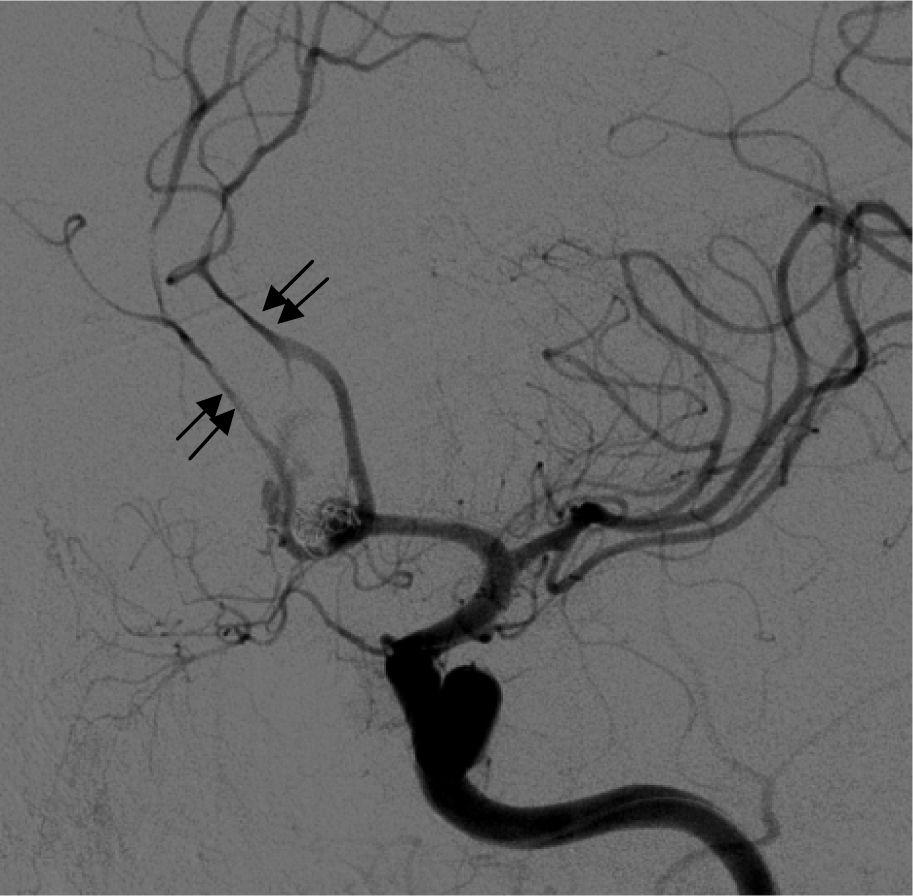 10 Figure 4. Left internal carotid artery angiogram demonstrating moderate to severe vasospasm (double arrows) involving both anterior cerebral arteries. Figure 5.