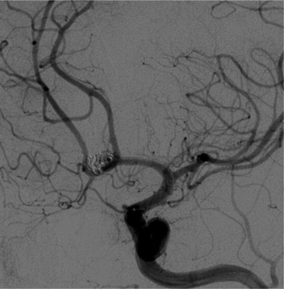 placement), the angiogram showed complete resolution of the vasospasm (Figure 5).