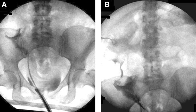 blind-ending ureter. Port placement was identical, and there were extensive adhesions surrounding the cecum.