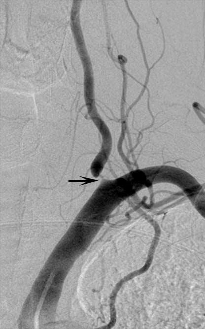 Sun Mi Kim et al ostium is also one of the common problems encountered when using this technique which may exaggerate preexisting focal stenosis of the ostium or show a false stenosis of an otherwise
