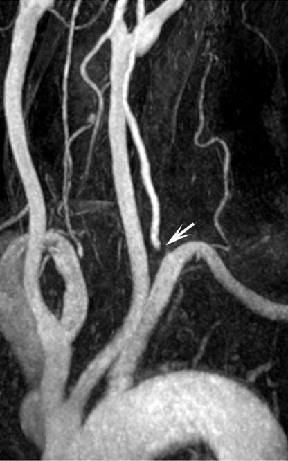 Although the mechanism of the pseudostenosis is not well understood, it is said that turbulent flow in the particular anatomic region causes intravoxel signal dephasing which results in decreased