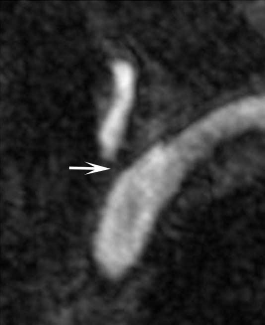 Because of the difference in the signal intensity of the ostial region from that of the other segments of the VA, this particular region appear stenotic on 3-dimensional (3D), full-thickness MIP