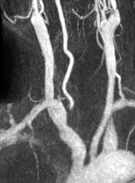 Diagnosis of Vertebral Artery Ostial Stenosis on Contrast-Enhanced MR Angiography rate of 2 ml/sec. Each bolus was immediately followed by a 20-mL saline flush.