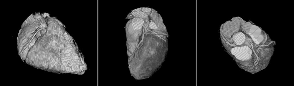 Figure 3. Reformatted volume-rendering images of the heart from one whole-heart scan. All major coronary arteries including RCA, LAD, and LCX are well depicted in this subject.