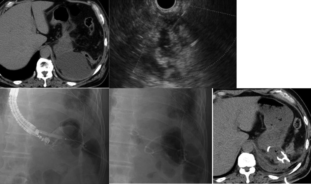 endoscopic ultrasound (EUS)-guided internal drainage, CT reveals another fluid collection on the left side of the previously drained abscess; D and E: Fluoroscopy image showing the placement of the