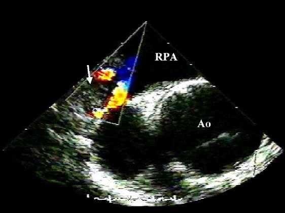 IMPROVEMENT OF DIAGNOSTIC ACCURACY OF TEE BY COLOR DOPPLER IN CASES WITH