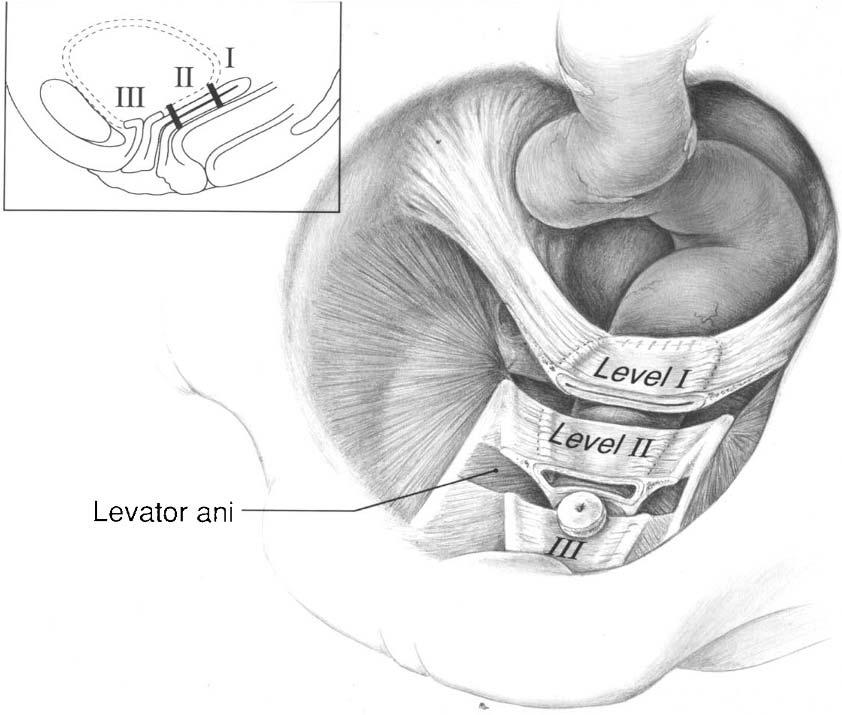 6 Wei and De Lancey tissue damage determines whether a woman has anterior, posterior, or vault prolapse.